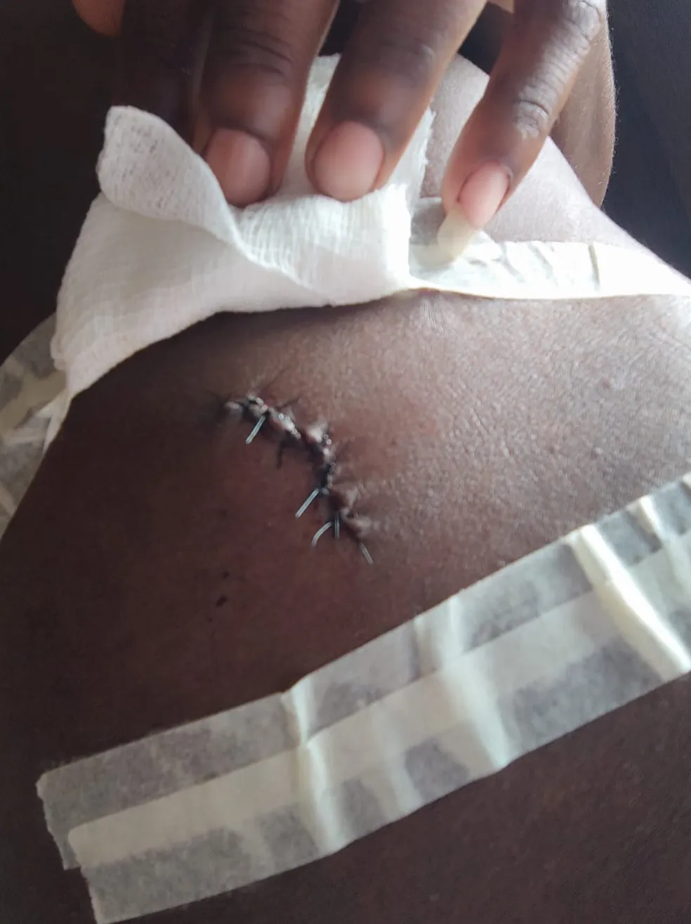 Motoboy agredido a muletadas durante entrega em BH diz que também foi ferido com canivete; 'eu nem sei quantos pontos foram